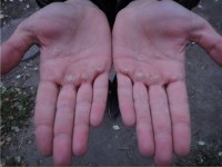 Спасаемся от мозолей при использовании кистевого эспандера