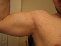 Растяжки на коже от занятий, как не допустить и как избавиться?